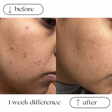 Load image into Gallery viewer, TURMERIC ANTI ACNE FACIAL SHEET MASKS