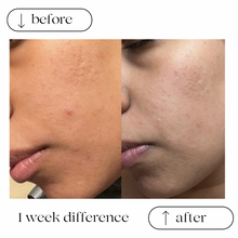 Load image into Gallery viewer, TURMERIC ANTI ACNE FACIAL SHEET MASKS